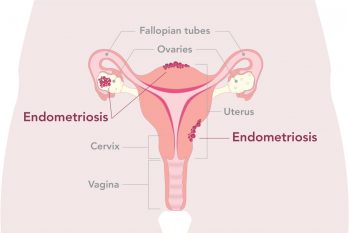 endometriosis_uterus_diagram